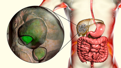 Canvas Print - Hydatid cyst of Echinococcus multilocularis