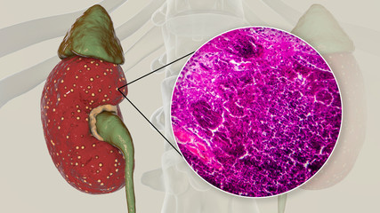 Sticker - Acute pyelonephritis, gross morphology and histopathology