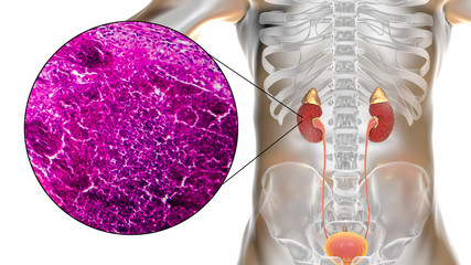 Poster - Acute pyelonephritis, gross morphology and histopathology