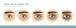 Dark Circles Under Eyes. Male Eye. Vector Illustration