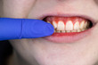 © Siniehina - Gum bleeding and inflammation close up. A man examined by a dentist. The diagnosis of gingivitis