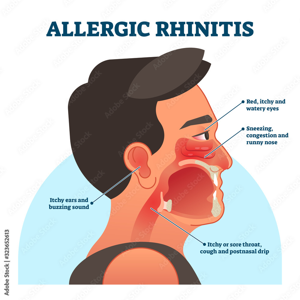 Allergic rhinitis medical diagram, vector illustration labeled ...