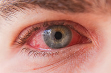 Macro Closeup Of  Conjunctivitis Infeced Red Eye