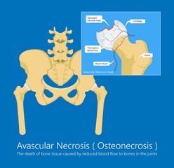 Avascular necrosis bone tissue disease