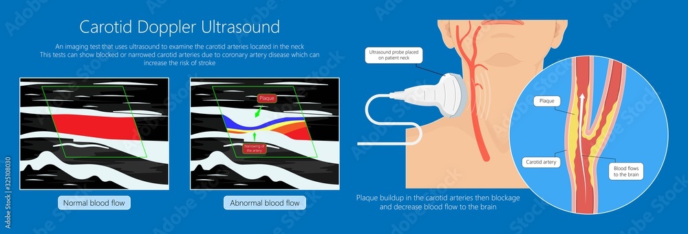 Coronary artery disease CAD diagnosis treatment Stock Vector | Adobe Stock
