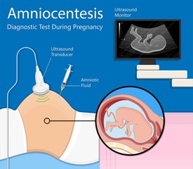 Amniocentesis diagnostic test treat LAB analysis chromosome DNA gene abnormal