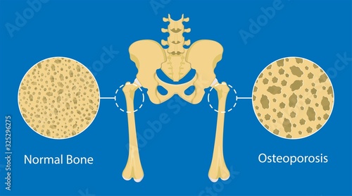 Cuadros en Lienzo Bone mineral density (BMD) osteoporosis dual energy X-ray