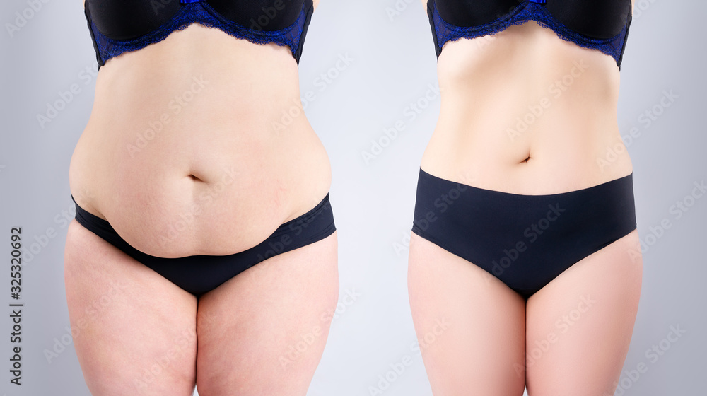 Woman's belly before and after weight loss on gray background - obrazy, fototapety, plakaty 