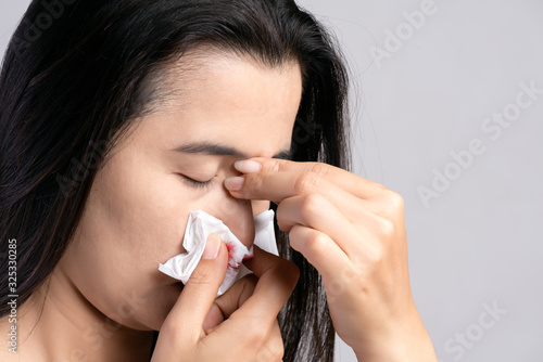 Cuadros en Lienzo Nosebleed , a young woman suffering from nose bleeding and using tissue paper for stop bleeding