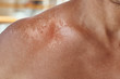 © Lazy_Bear - Sunburn on the shoulders of men. Shoulders with a hurt skin fron sun burn, closeup