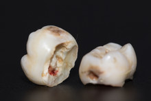 Tooth Decayed Caries On A Black Background