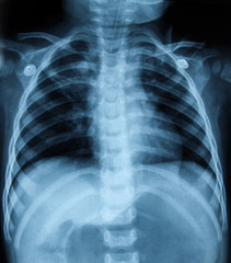 x- ray of chest