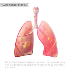 Poster - Vector illustration of lung cancer