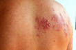 © นายคมสันต์ บุญพบ - Shingles (Disease),Herpes zoster, severe dermatitis due to a viral infection and blisters on body