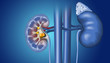 Kidney stones in kidney and ureter, medically illustration