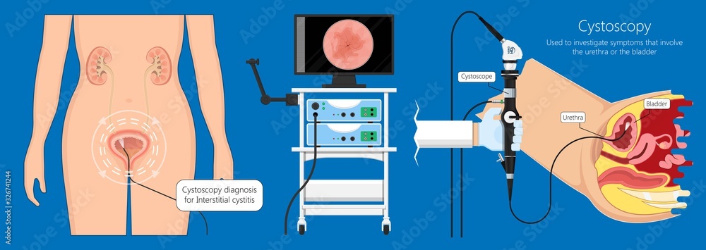 Cystoscopy diagnose bladder diseases and conditions exam treat benign ...