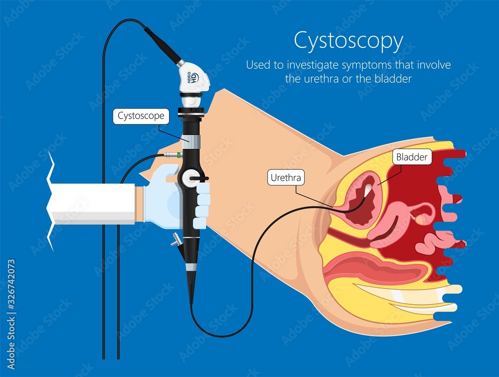Cystoscopy diagnose bladder diseases and conditions exam treat benign ...