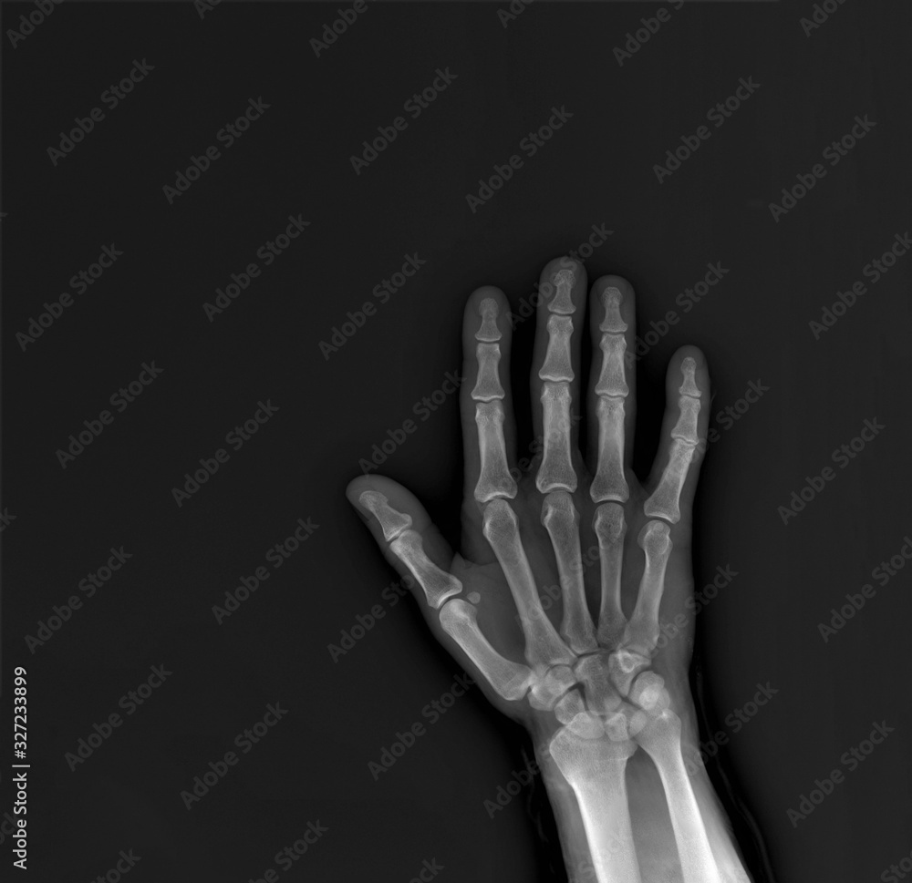 x-ray of the hand and wrist bones Stock Photo | Adobe Stock
