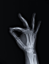 X-ray Of The Hand And Wrist Bones