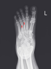 X-ray foot and ankle showing Metatarsal fractures .