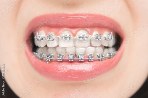 Ceramic Braces Зображення - огляд 5,070 Стокові фото, векторні зображення й віде
