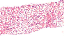 Photomicrograph Of Liver Biopsy Histology (pathology) Showing Steatosis ("fatty Liver"), Which May Be Associated With Diabetes Mellitus, Alcohol Abuse, Or Toxins. 