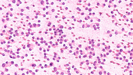 Wall Mural - Squash prep cytology smear of a pituitary adenoma, a benign tumor of the pituitary, a hormone producing gland at the base of the brain (alcohol fixed, H&E stain)