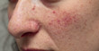 Close up view of young caucasian girl face suffering from rosacea.  characterized by facial redness. Small and superficial dilated blood vessels are seen in detail. No make-up. Medicine concept.