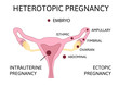 © Ana Krasavina - Heterotopic Pregnancy. extra-uterine ectopic pregnancy and intrauterine pregnancy occur simultaneously