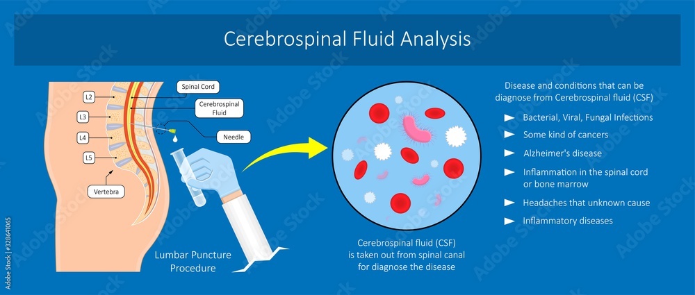 lumbar puncture spinal tap canal diagnostic collect sample patient ...
