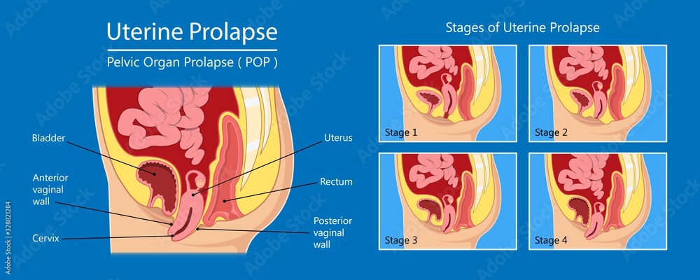 Prolapzo Pelvic floor prolapse type uterine uterus biofeedback pelvic floor ...