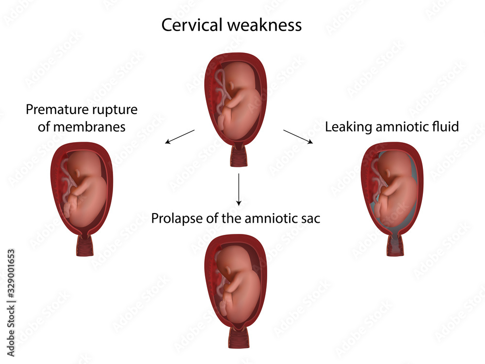 Cervical weakness. Prolapse of the amniotic sac, leaking amniotic fluid