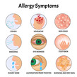 Symptoms of Allergies Skin rash, Allergic skin itching, Tearing from the eyes, Cough, Sneezing, Runny nose, Headache, Redness of the eyes. Infographics allergy. Vector illustration on isolated