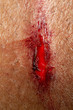© Alessandro Grandini - Blood on fresh large open wound of human arm skin