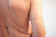© Ratchaneeboon - Back view of a Caucasian showing Seborrheic Keratosis at his right upper arm.  The white mole has cracks.  It is most common noncancerous skin growths in adults.  Not contagious.