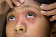 Southeast Asian ethnicity teenage girl with circular shape skin rash on her face around the eye and nose, Tinea Corporis dermatitis skin problem