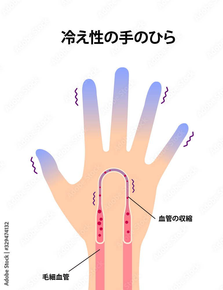 末端冷え性の手 イラスト 冷え性の原因 Wall Mural Wallpaper Murals Barks