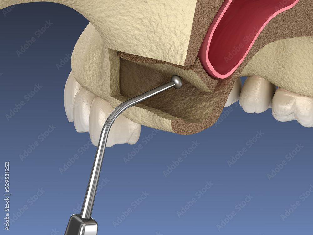 Sinus Lift Surgery - Moving sinus membrane. 3D illustration - obrazy, fototapety, plakaty 