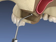 Sinus Lift Surgery - Moving sinus membrane. 3D illustration