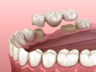 Wall Mural - Dental bridge of 3 teeth over molar and premolar. Medically accurate 3D illustration of human teeth treatment