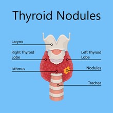 Thyroid Cancer Disease Nodules Ultrasound Screening Check Medical Treat Fine Needle Aspiration Lumps Test Lab Gland Neck Pain Graves FNA FNAB Large Toxic Diagnostic Exam Collect Lymph Nodes Cell