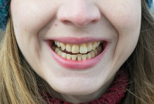 Yellow Teeth Of A Girl, Fluorosis. Smoker's Problem Teeth Caused By Fluoride, Smoking, Or Coffee. Brown Tooth Enamel Due To Illness And Drugs. Light Skin And A Wide Smile. Natural Photo