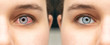 Comparison closeup view of eye before and after eyedrop treatment. Female red irritated eye. Mirroring view. Healthcare and eyecare concept...