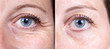 © Alessandro Grandini - Collage comparison of before and after beauty care. Closeup view of female eyes. ..