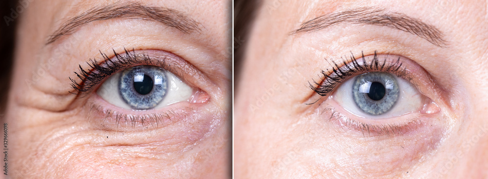 Before and after beauty care comparison. Wrinkles removing. Closeup view of aged caucasian women eyes. .. - obrazy, fototapety, plakaty 