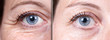 Before and after beauty care comparison. Wrinkles removing. Closeup view of aged caucasian women eyes. ..