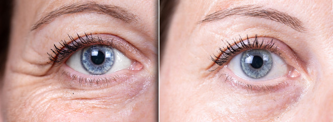before and after beauty care comparison. wrinkles removing. closeup view of aged caucasian women eye