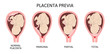 Different Placental Locations During Pregnancy. Major and Normal placenta previa, total and partial.
