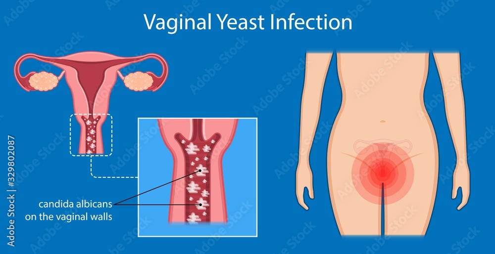 vaginal yeast infections treatment applicator symptoms natural remedies