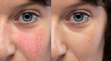 Collage Comparing Healthy Skin And Face Suffering Rosacea, Visible Blood Vessels And Capillaries. Caucasian Woman Face Closeup. Medicine And Healthcare Concept...